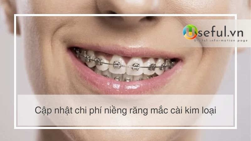 Cập nhật chi phí niềng răng mắc cài kim loại