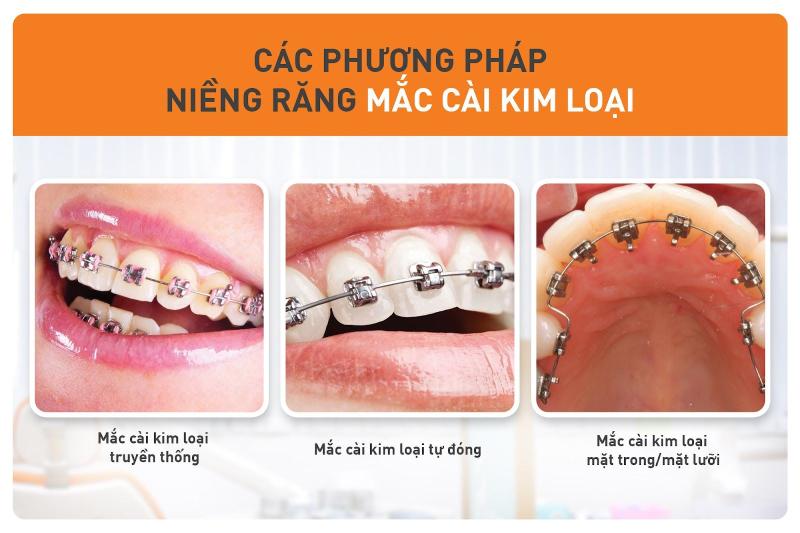 Cập nhật chi phí niềng răng mắc cài kim loại