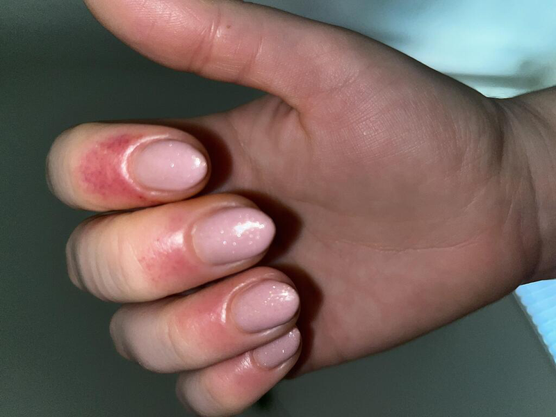 Những nguyên nhân khi làm nail xong bị ngứa cần lưu ý 