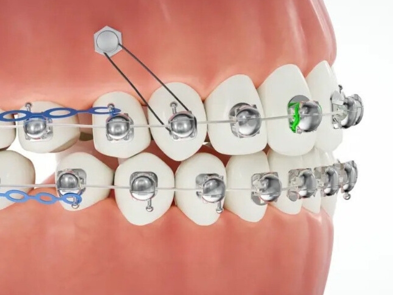 Cập nhật chi phí niềng răng mắc cài kim loại