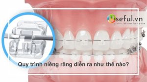 Quy trình niềng răng diễn ra như thế nào?