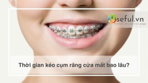 Thời gian kéo cụm răng cửa mất bao lâu?