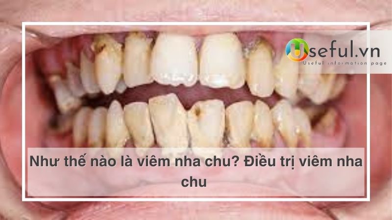 Như thế nào là viêm nha chu? Điều trị viêm nha chu