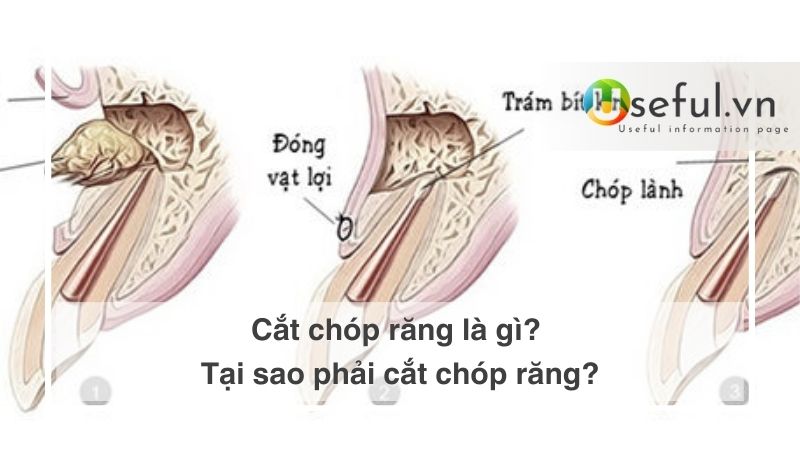 Cắt chóp răng là gì? Tại sao phải cắt chóp răng?