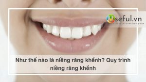 Như thế nào là niềng răng khểnh? Quy trình niềng răng khểnh