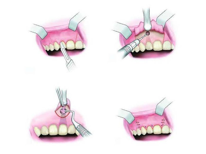 Cắt chóp răng là gì? Tại sao phải cắt chóp răng?