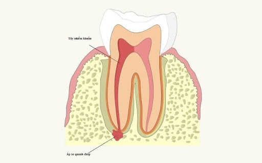 Cắt chóp răng là gì? Tại sao phải cắt chóp răng?