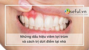 Những dấu hiệu viêm lợi trùm và cách trị dứt điểm tại nhà