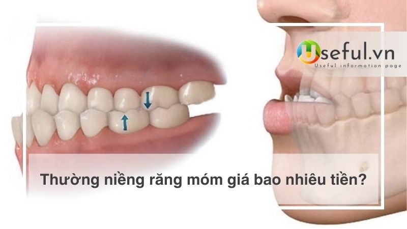 Thường niềng răng móm giá bao nhiêu tiền