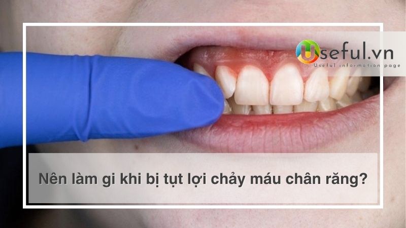 Nên làm gi khi bị tụt lợi chảy máu chân răng?