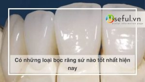 Có những loại bọc răng sứ nào tốt nhất hiện nay