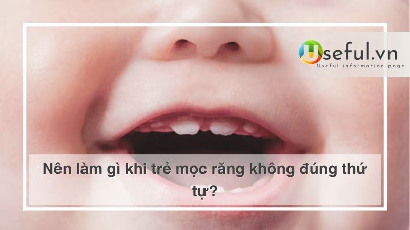 Nên làm gì khi trẻ mọc răng không đúng thứ tự?