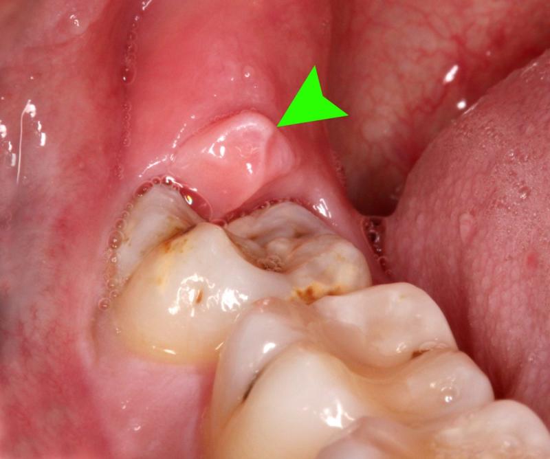 Những dấu hiệu viêm lợi trùm và cách trị dứt điểm tại nhà