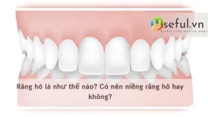 Răng hô là như thế nào? Có nên niềng răng hô hay không?