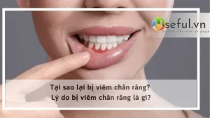 Tại sao lại bị viêm chân răng? Lý do bị viêm chân răng là gì?