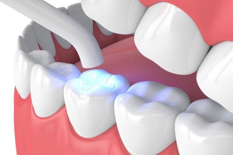 Dịch vụ hàn răng tại Parkway luôn được khách hàng đánh giá cao
