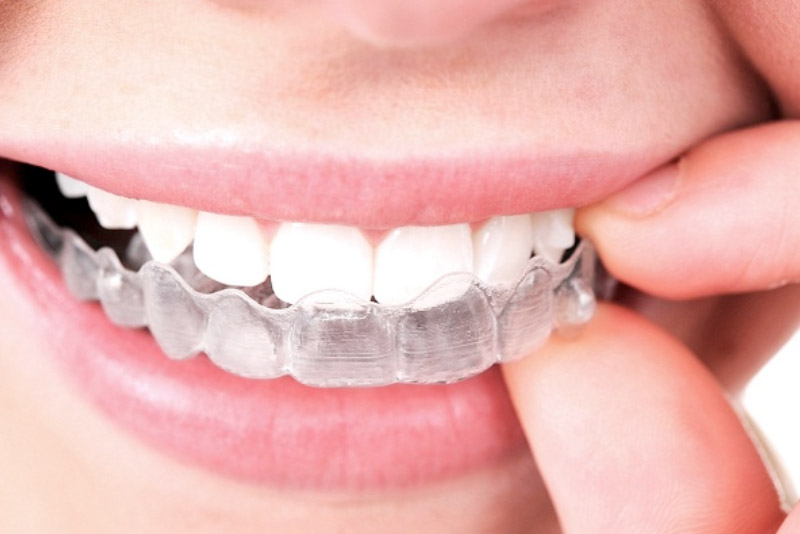 Niềng răng Invisalign mang lại tính thẩm mỹ cao cho người niềng