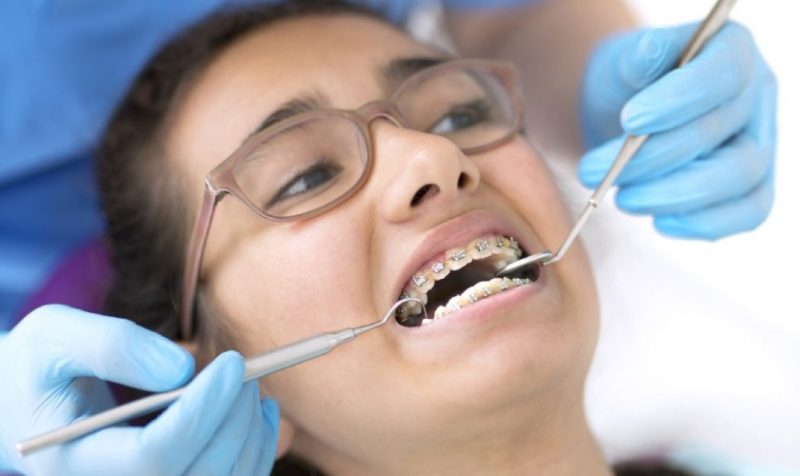 Quá trình niềng răng diễn ra bao lâu phụ thuộc nhiều yếu tố khác