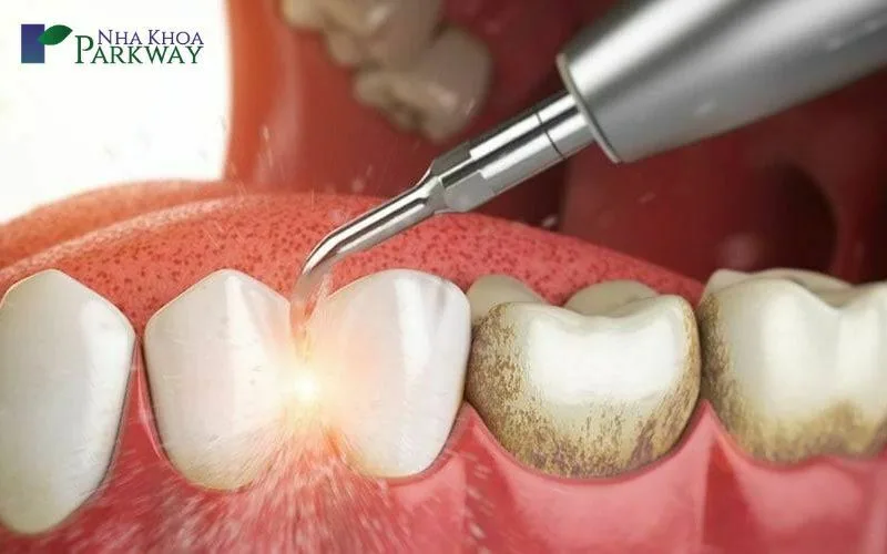 Có nên lấy cao răng không? Giá lấy cao răng Hà Nội là bao nhiêu? 1 Giá lấy cao răng Hà Nội dao động từ 300 - 700 ngàn đồng/ lần