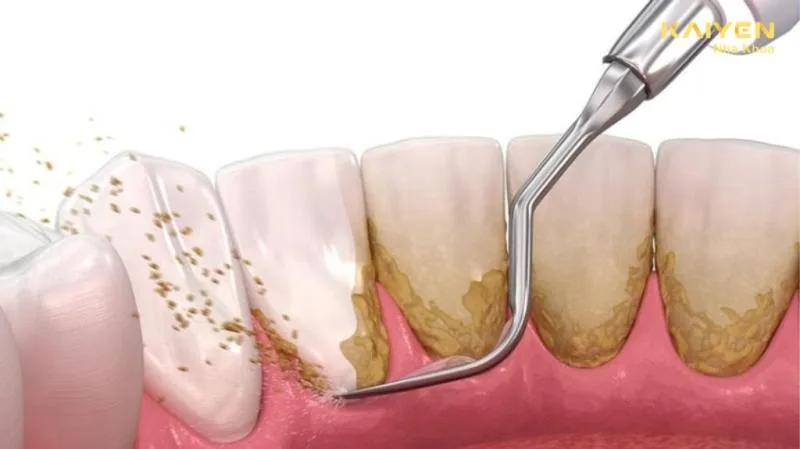 lấy cao răng có đau không? Những thông tin mà bạn cần biết