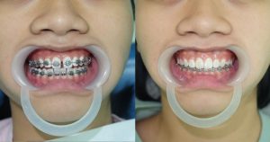 Tất tần tật về chi phí niềng răng thưa