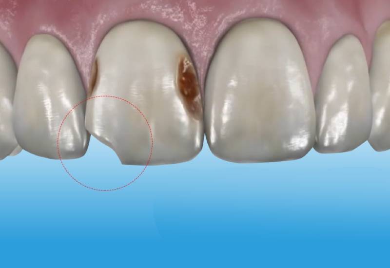Hình ảnh răng sâu ở mức độ vừa