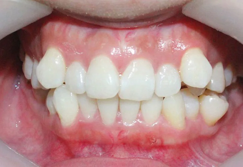 Răng khấp khểnh có thể xử lý được nhờ kỹ thuật niềng răng hiện đại
