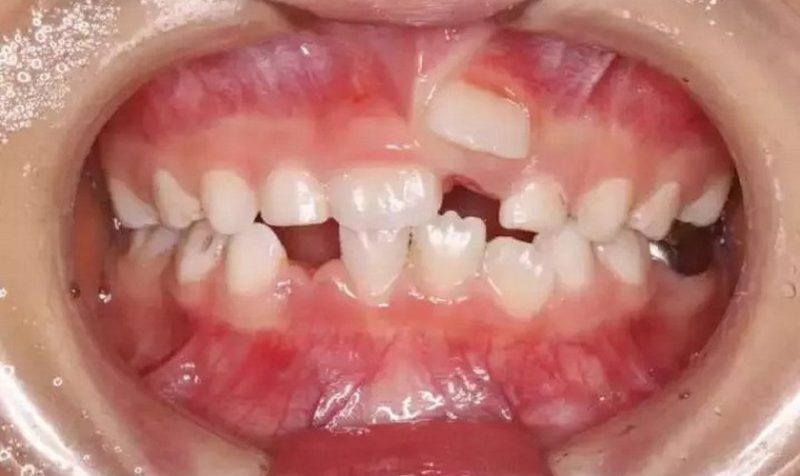 Răng mọc trên lợi ở trẻ em là tình trạng răng mọc sai vị trí