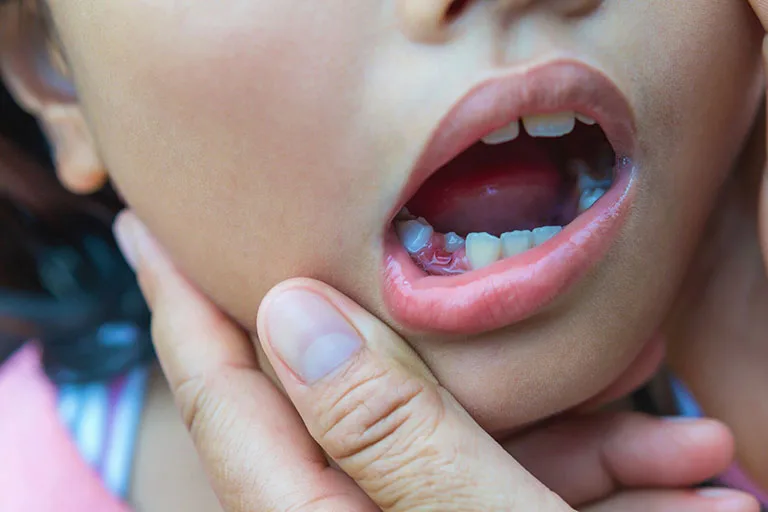 Lấy tủy răng sữa có mọc lại không? Có nên lấy tủy răng trẻ em? 1 Việc lấy tủy răng sữa sẽ không gây ảnh hưởng cho răng vĩnh viễn sau này