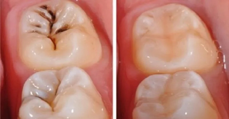 Sâu răng nhẹ thường không gây đau nhưng không trị kịp thời sẽ gây nặng lên khó chữa
