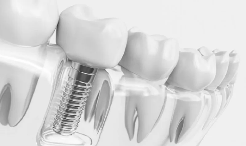 Trồng implant răng hàm có đau không? Giá bao nhiêu? 1 Trồng implant răng hàm giúp củng cố chức năng nhai