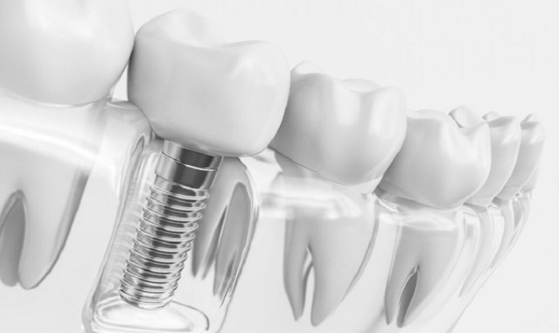 Trồng implant răng hàm giúp củng cố chức năng nhai