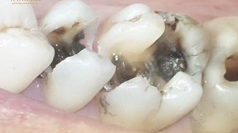 Nhổ răng sâu bao nhiêu tiền? Bao lâu nên khám nha khoa tổng quát?