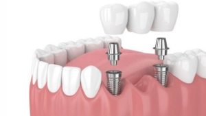 Làm răng implant nha khoa là gì? Lý do nên trồng răng implant