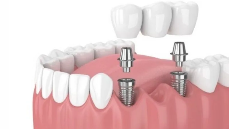 Làm răng implant nha khoa là gì? Lý do nên trồng răng implant