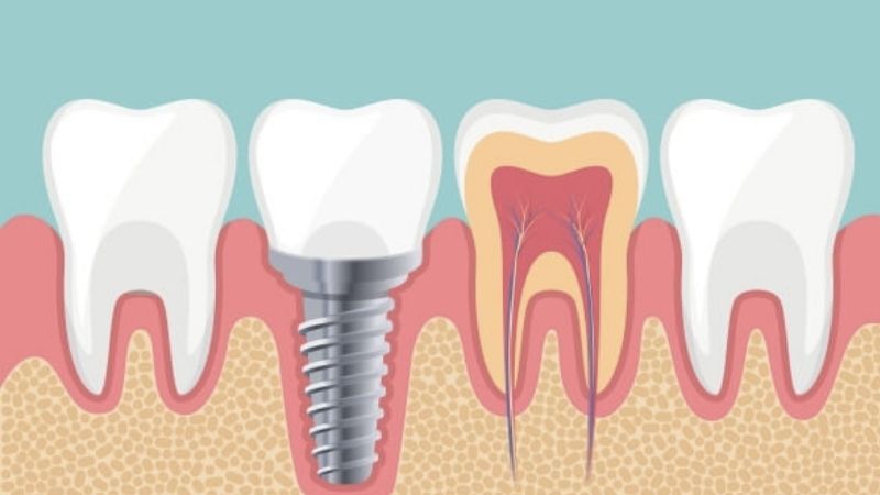 Làm răng implant nha khoa là gì? Lý do nên trồng răng implant