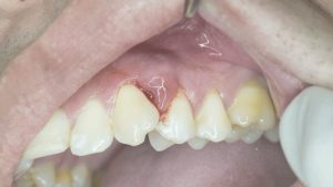 Nguyên nhân dẫn đến áp xe răng? Làm thế nào khi bị áp xe răng ở trẻ em?