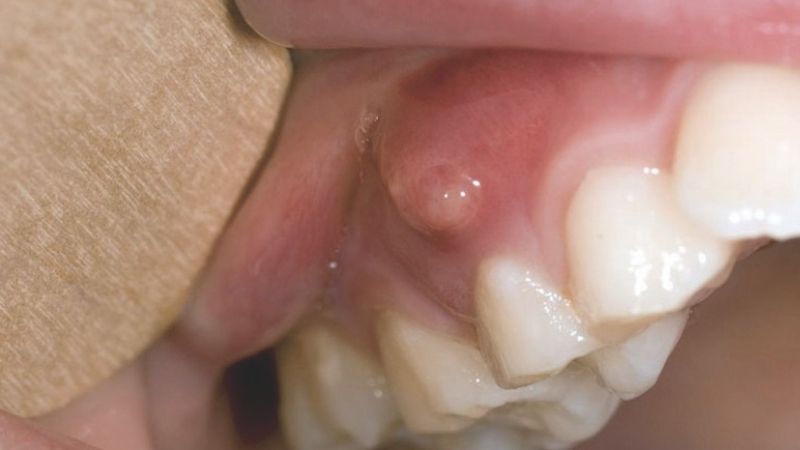 Nguyên nhân dẫn đến áp xe răng? Làm thế nào khi bị áp xe răng ở trẻ em?