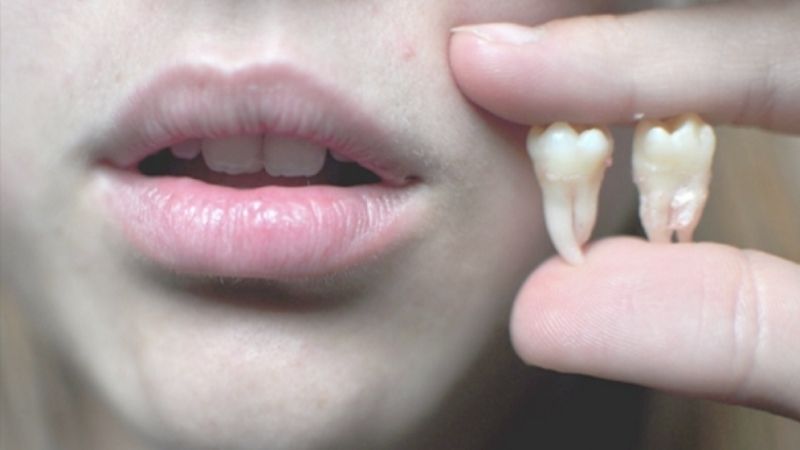 Bảng giá nhổ răng khôn tại nha khoa ParkWay năm 2025