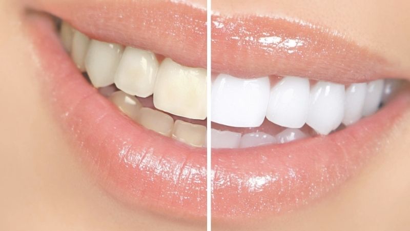 Nha khoa thẩm mỹ thường tẩy trắng răng bao nhiêu tiền? 