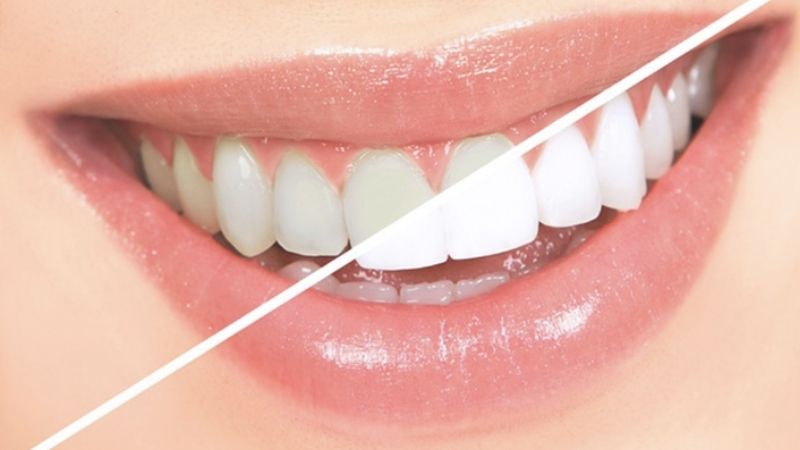 Nha khoa thẩm mỹ thường tẩy trắng răng bao nhiêu tiền? 
