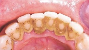 Khi bị cao răng có cần đi khám nha khoa tổng quát?