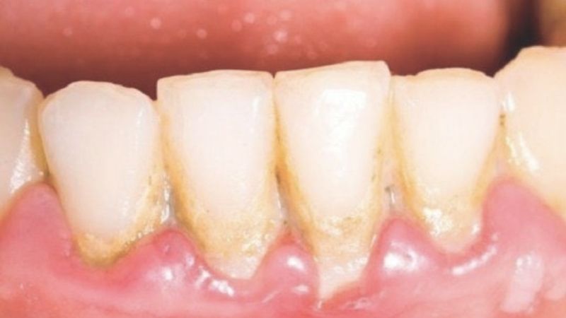 Khi bị cao răng có cần đi khám nha khoa tổng quát?