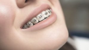 Niềng răng bao nhiêu tiền khi làm nha khoa thẩm mỹ?