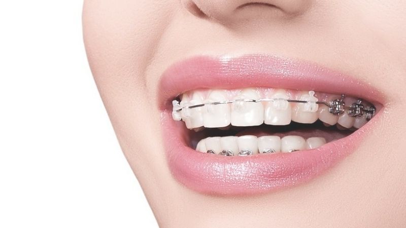 Niềng răng bao nhiêu tiền khi làm nha khoa thẩm mỹ?