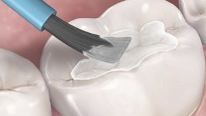 Chi phí trám răng cho trẻ em giá bao nhiêu? Bao lâu nên khám nha khoa trẻ em?