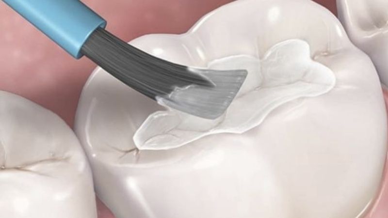 Chi phí trám răng cho trẻ em giá bao nhiêu? Bao lâu nên khám nha khoa trẻ em?