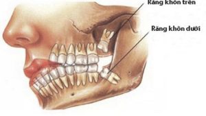 Răng số 8 là răng gì? Có nên nhổ răng số 8 hay không?