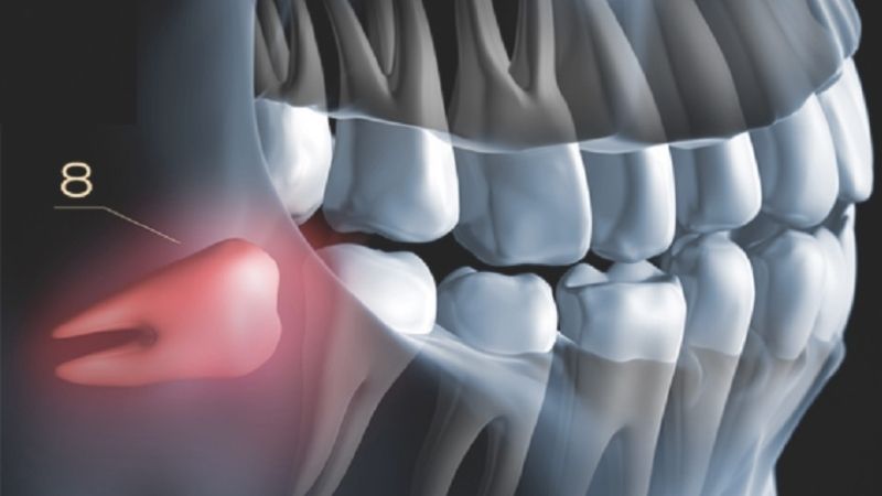 Răng số 8 là răng gì? Có nên nhổ răng số 8 hay không?