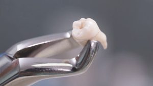 Nhổ răng khôn giá bao nhiêu? Và bao lâu nên khám nha khoa tổng quát